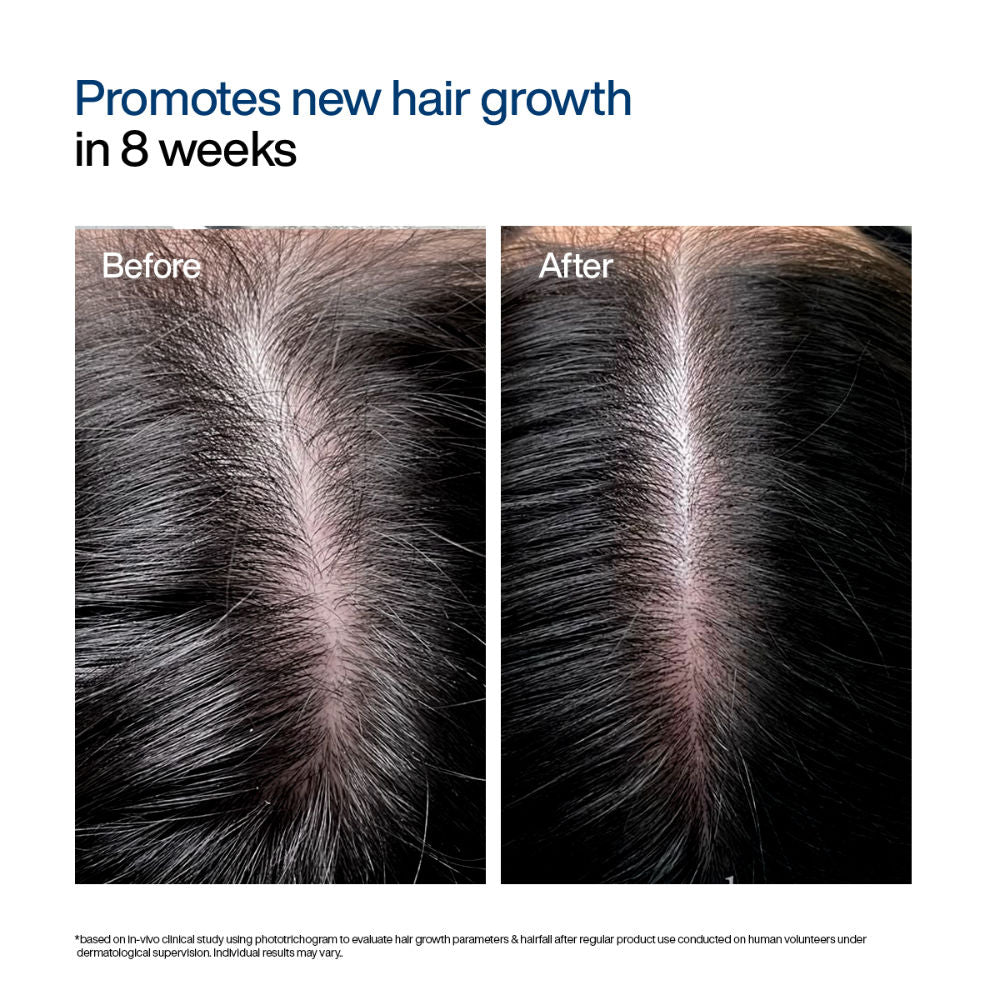 Wishcare Hair Growth Serum Concentrate with Redensyl & Rosemary - In-Vivo Tested - Controls Hairfall (30ml)
