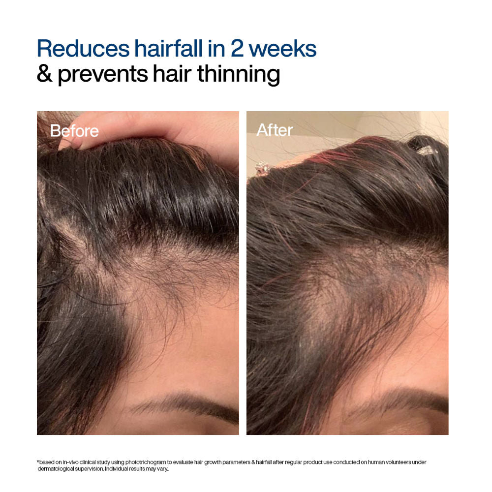 Wishcare Hair Growth Serum Concentrate with Redensyl & Rosemary - In-Vivo Tested - Controls Hairfall (30ml)