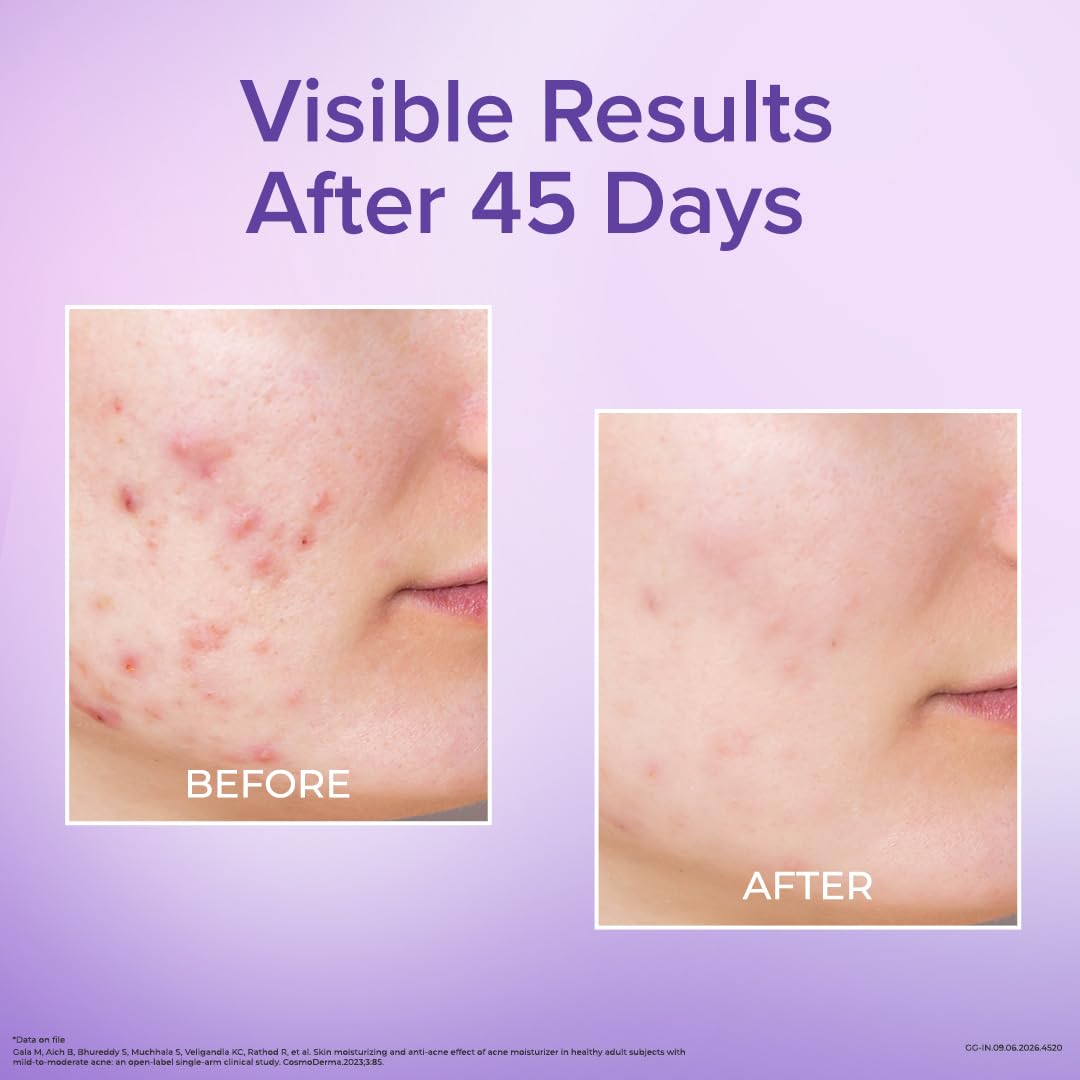 Dr. Reddy's Venusia Acne Moisturizing Gel For Oily & Acne Prone Skin | Ultra-light Sebum Control Formula With 5%+ Hydrating Complex, Polyglutamic Acid, 4-D Hyal