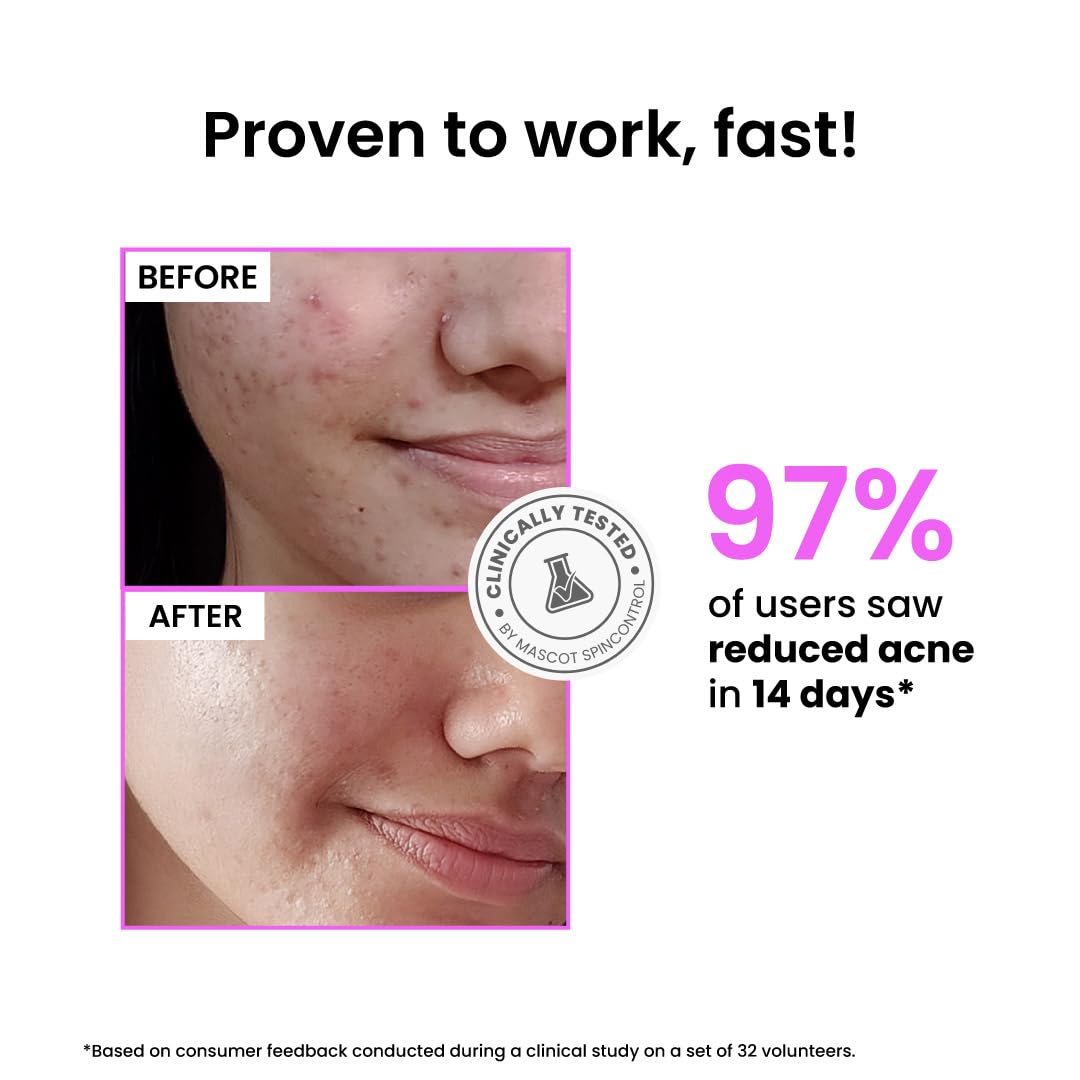 Foxtale 12% Niacinamide Face Serum with Azelaic Acid for Brightening & Oil Control | Reduces Acne, Blemishes & Acne Marks | Brightens & Smoothens Skin | Face Serum for Women & Men | 30 ml