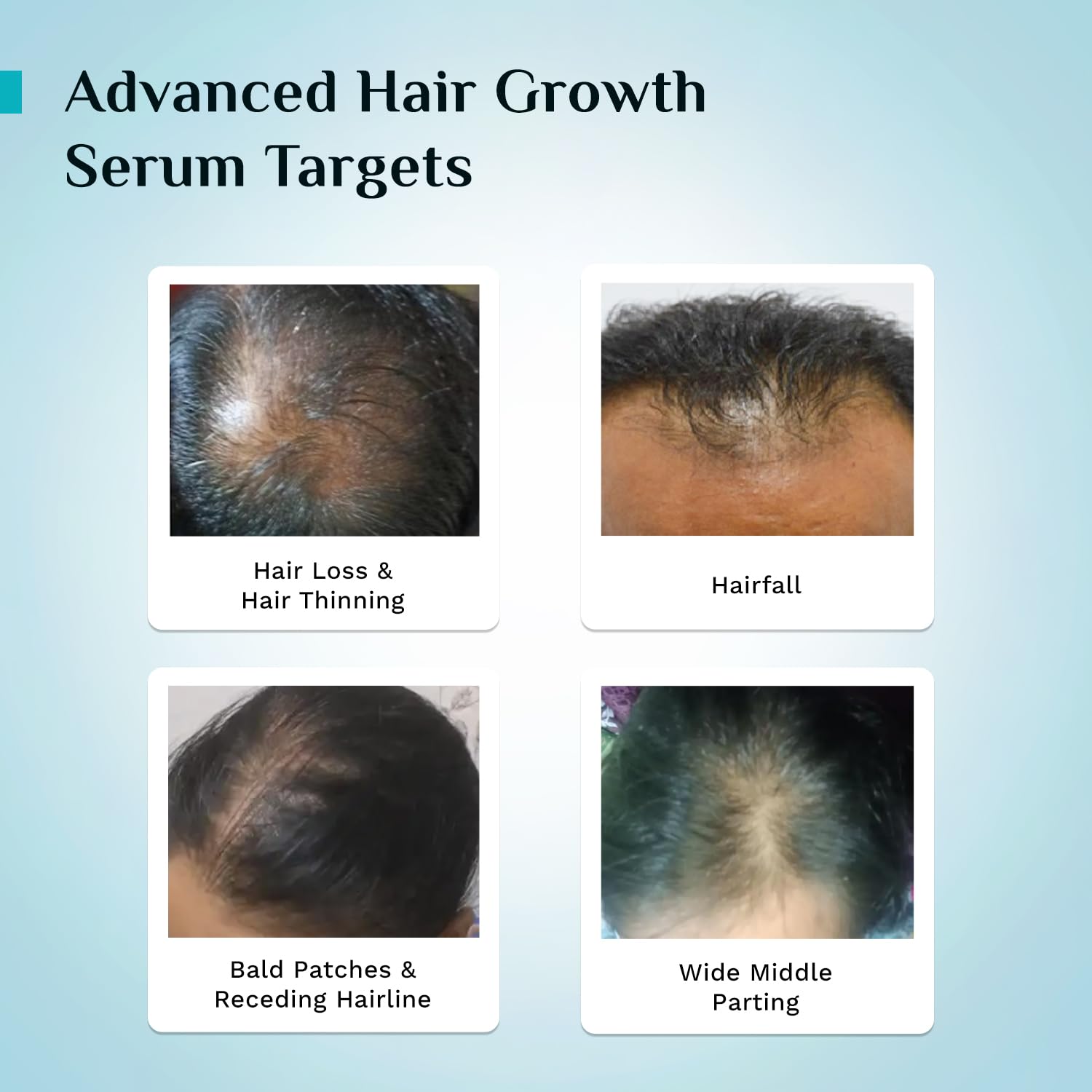 Pilgrim 3% Redensyl, 4% Anagain & 5% Capilia Stem Advanced Hair Growth Serum Roll-on for Scalp with Korean Black Rice & Rosemary | Control Fall, Stimulate Regrowth, Increase Density | (25ml)