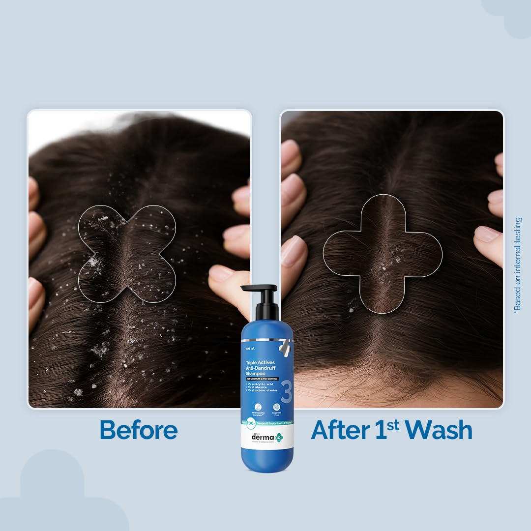 The Derma Co Triple Actives Anti-Dandruff Shampoo | Up To 100%* Dandruff Reduction | 2% Salicylic Acid + 1% Climbazole + 1% Piroctone Olamine & Menthol | ZPTO-Free | pH 5.5, Non-Drying & Sulphate-Free formula | Suitable for Men & Women | 400 ml