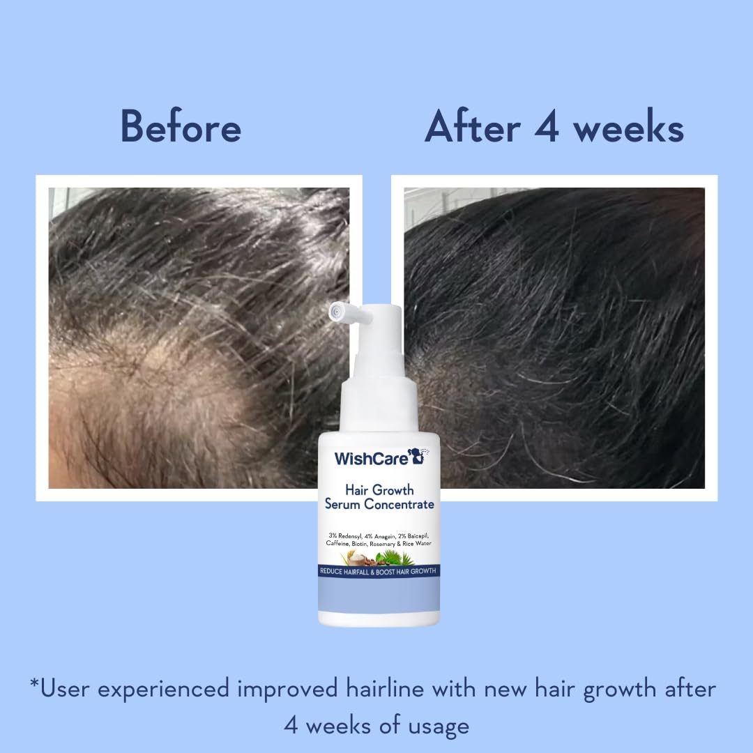 WishCare Hair Growth Serum For Scalp | 94% Saw New Hair Growth | Redensyl & Rosemary Oil | 100% Saw Hairfall Reduction | In-Vivo Tested | For Men & Women | 30ml