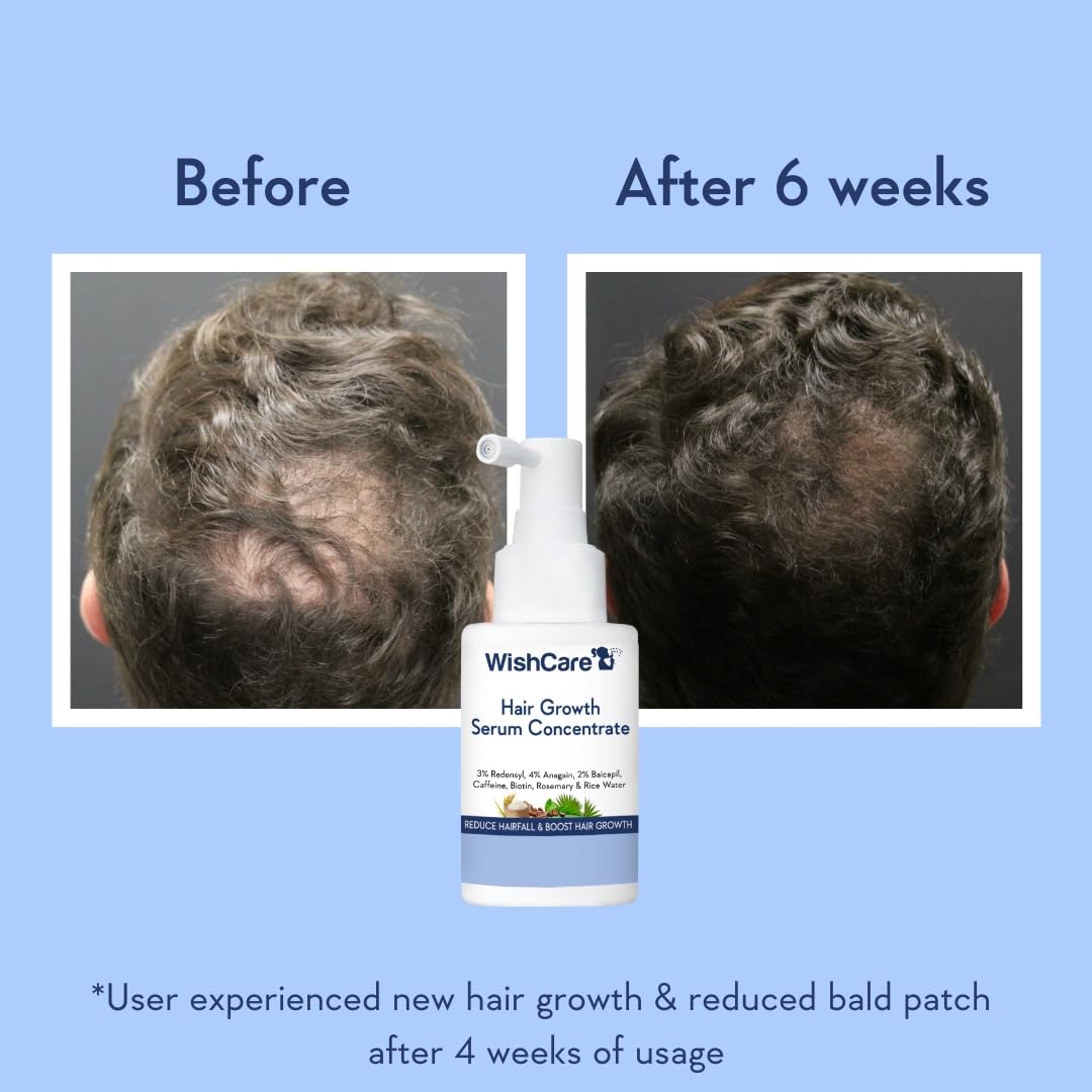 WishCare Hair Growth Serum For Scalp | 94% Saw New Hair Growth | Redensyl & Rosemary Oil | 100% Saw Hairfall Reduction | In-Vivo Tested | For Men & Women | 30ml