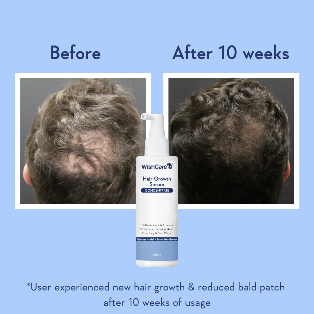 WishCare Hair Serum 100ml with Redensyl, Anagain, Baicapil, Biotin, Caffeine & Rice Water – Lightweight Daily Hair Care Serum for Fuller Looking, Healthier Hair – For Men & Women
