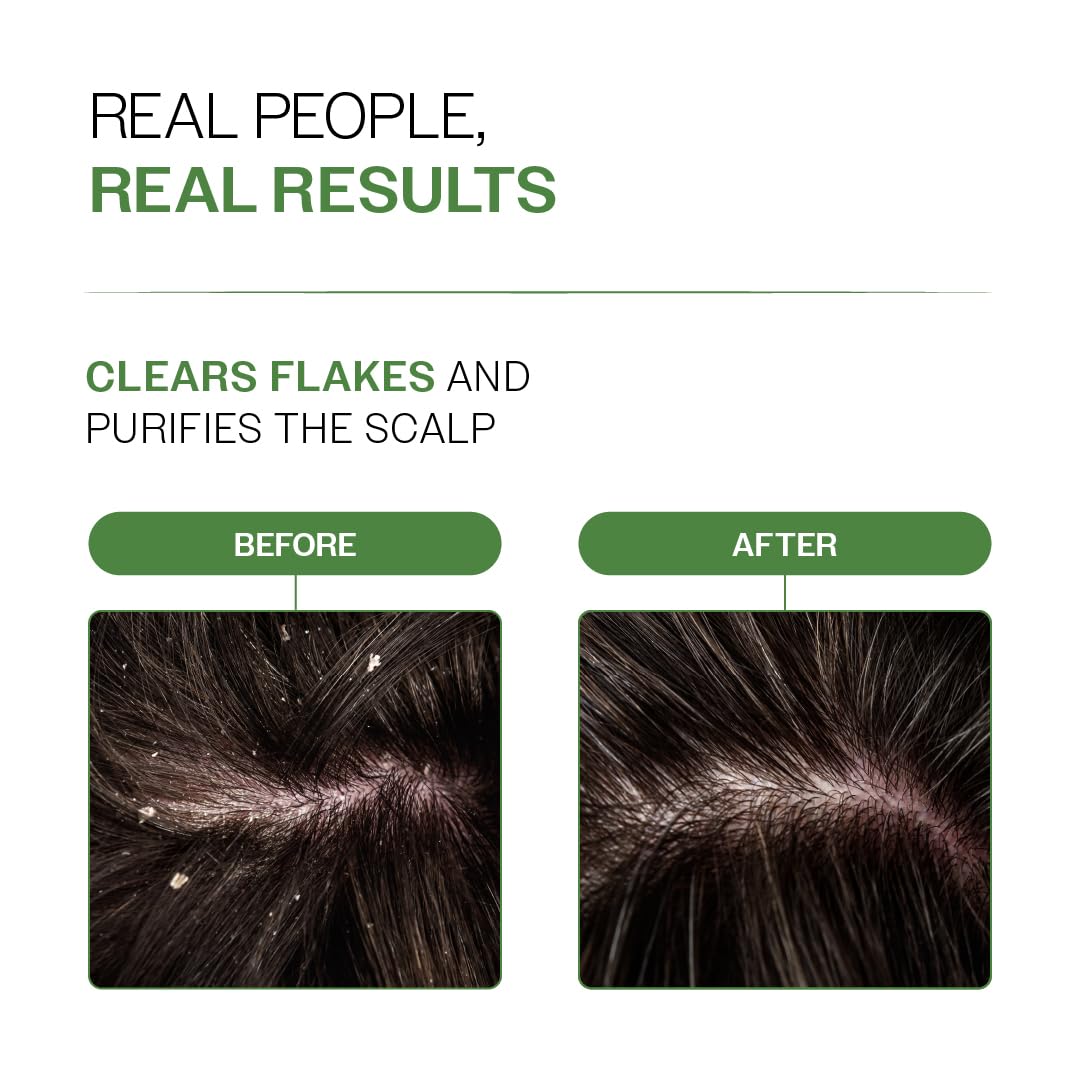 Bare Anatomy Nature x Science Dandruff Control Scalp Spray for Dandruff & Flake Reduction with Neem Leaf, Lemon & Tea Tree Extract | Lightweight & Non-Sticky Formula | Refreshes & Soothe Scalp | 200ml