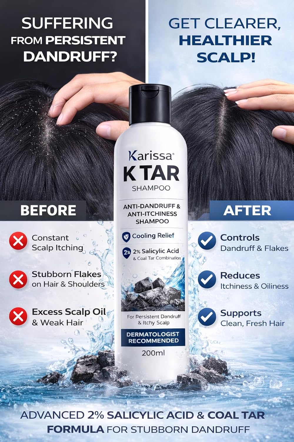 Karissa K TAR Anti Dandruff Shampoo with 2% Salicylic Acid & Coal Tar | Reduces Dandruff, Itchy Scalp & Flakes | Deep Scalp Cleansing & Oil Control | Cooling Re
