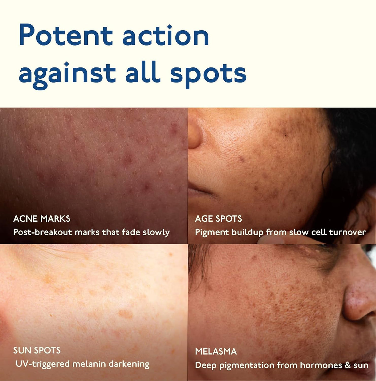 Asaya Advanced Dark Spot Targeting Gel | Reduces Pigmentation, Post-Inflammatory Hyperpigmentation, Acne Marks & Scars | MelaMe™ Complex, Spicules & Alpha Arbut
