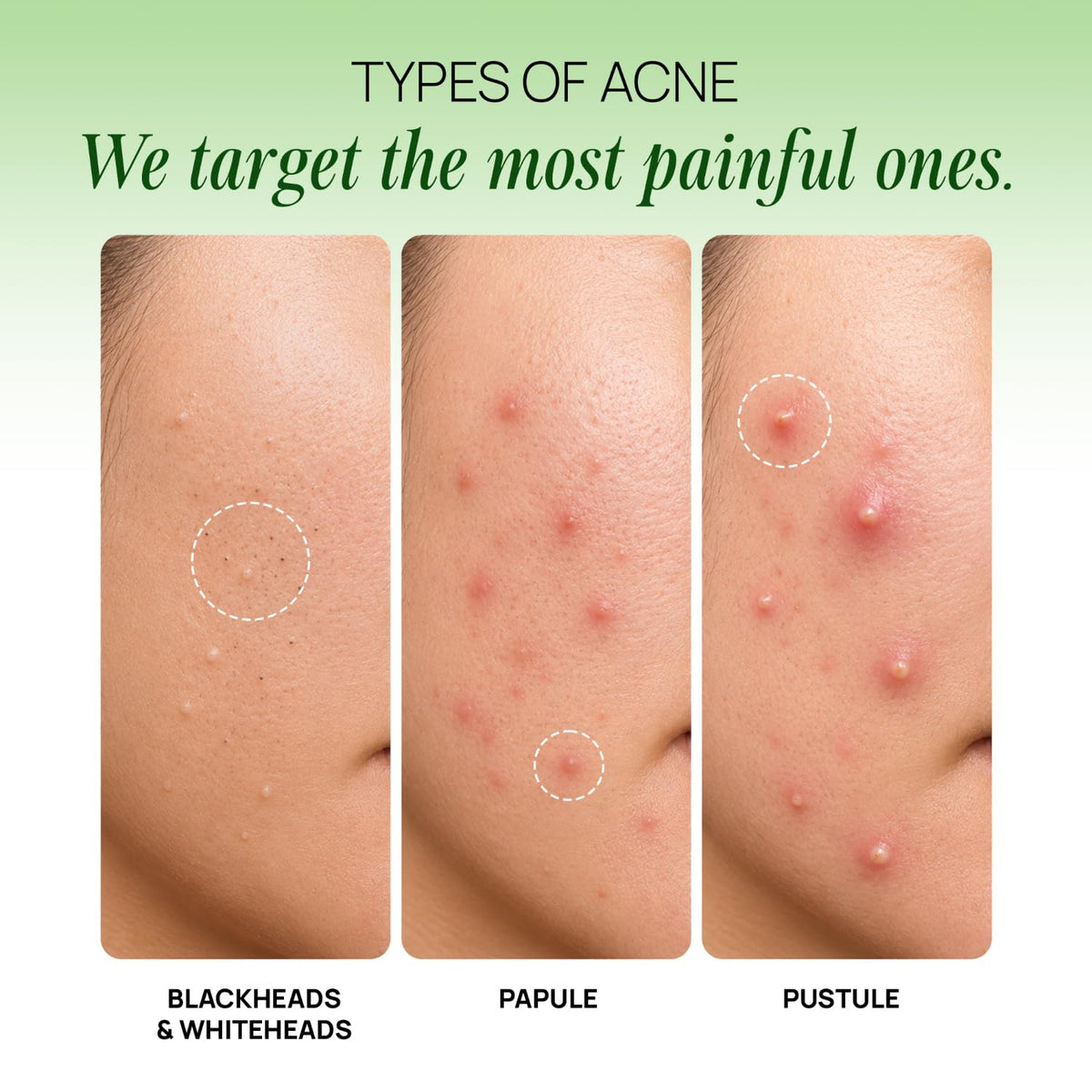 OZiva Acne Care + Milk Thistle | Acne Supplements with Pomegranate Extract for Sebum Balance & Skin Hydration | Soothes Skin Inflammation with Milk Thistle | Bl