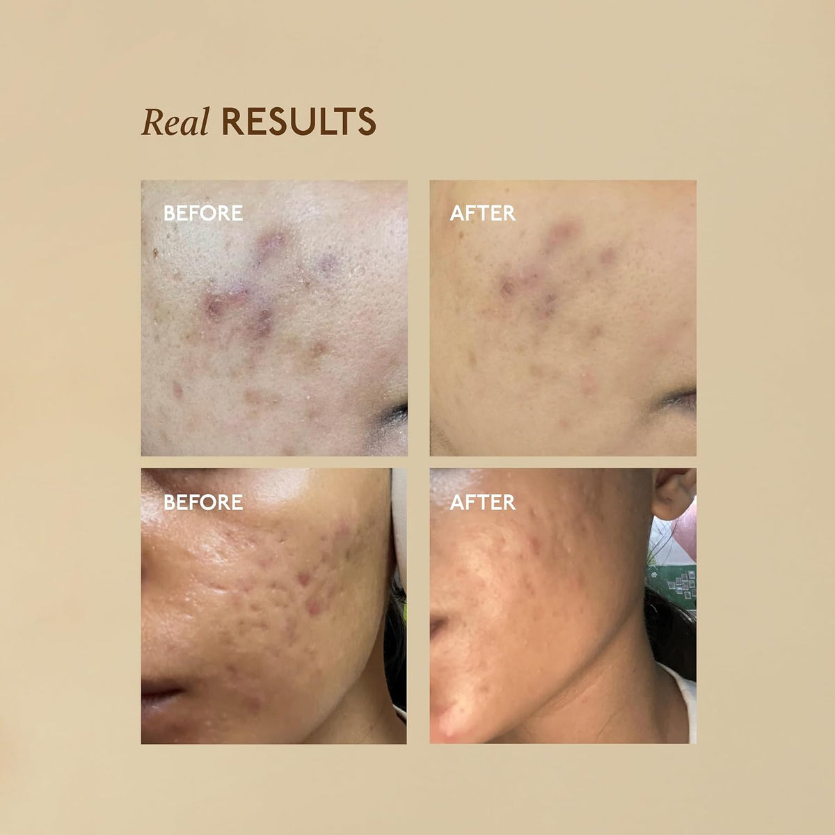 Asaya Advanced Spot Pigmentation Face Serum | Reduces Dark Spots, Melasma, Acne Marks & Hyperpigmentation | MelaMe™ Complex, Niacinamide & Alpha Arbutin | Evens