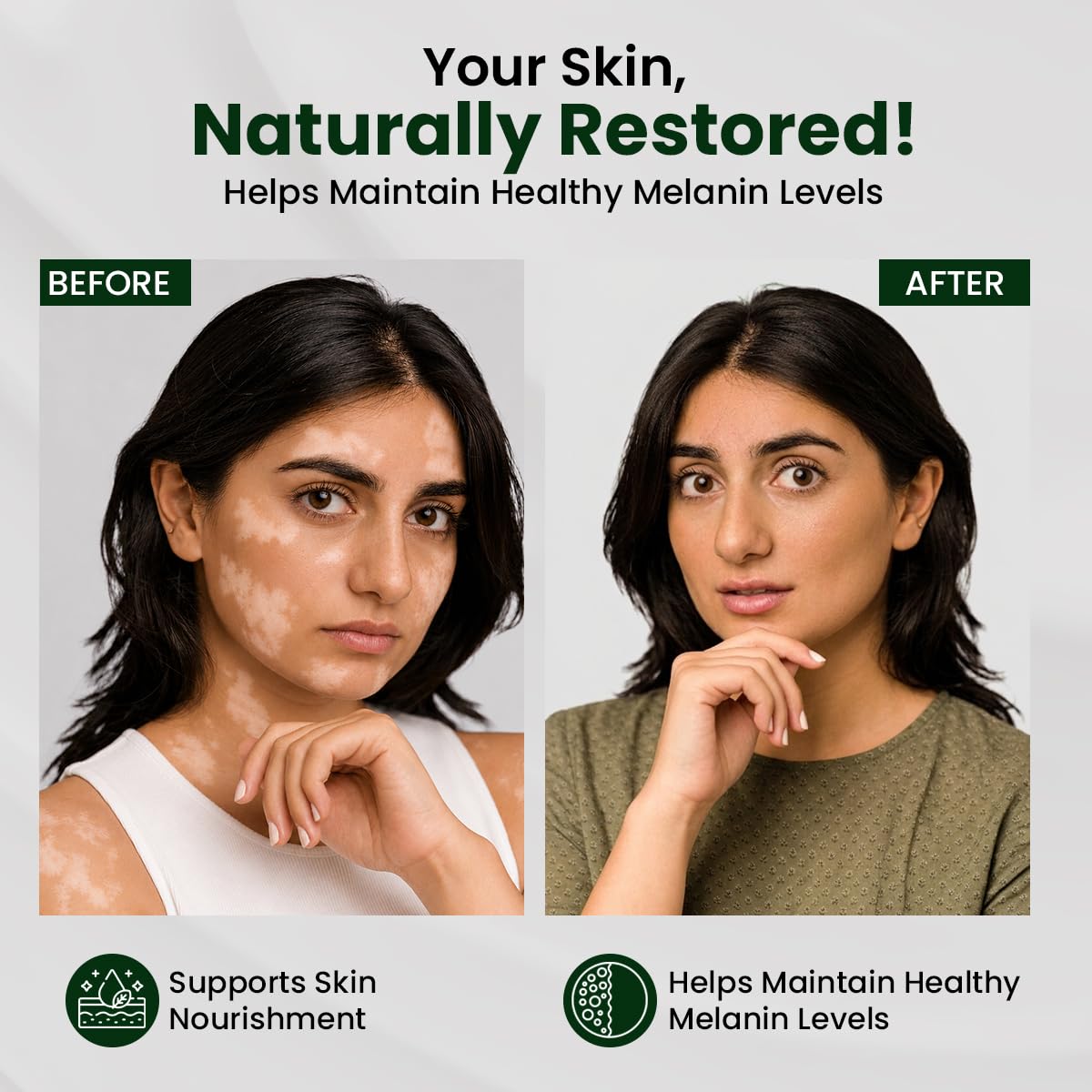 Sheopal's Vitiloma Combo | Skin Lotion & Capsules for Healthy-Looking Skin Tone | White Patches, Discoloration of Scar Removal, Piebald, for men and women ((Com