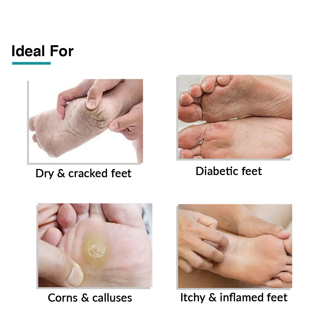 Fix Derma - Foobetik Foot Cream – Dry & Cracked Heels Cream  9% Lactic Acid, 1.5% Apple Cider Vinegar, 4% Tea Tree Oil (50g)