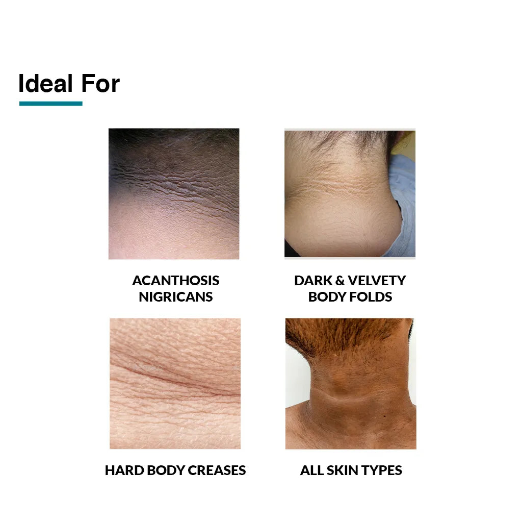 Fix Derma - 10% Lactic Acid + 0.1% Retinol - Nigrifix Cream- Reduces Dark Elbows, Knees, Underarms, & Neck (100g)