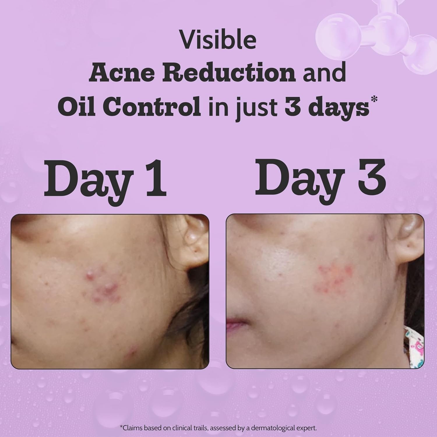 Chemist At Play - 2% Salicylic Acid Acne Control Face Serum (30ML)