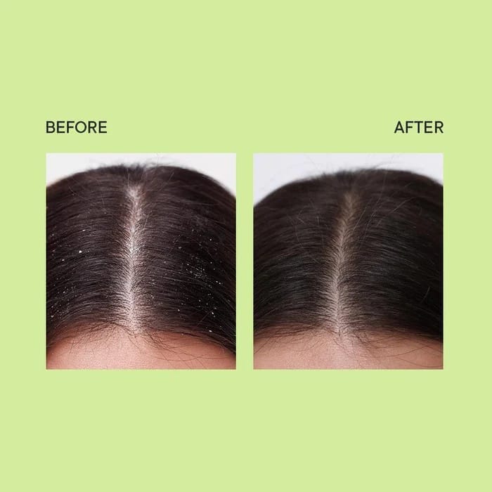 Quench - Dandruff Control Ampoule With Tea Tree Extracts Enriched With Tamanu Oil And Witch Hazel (100ML)